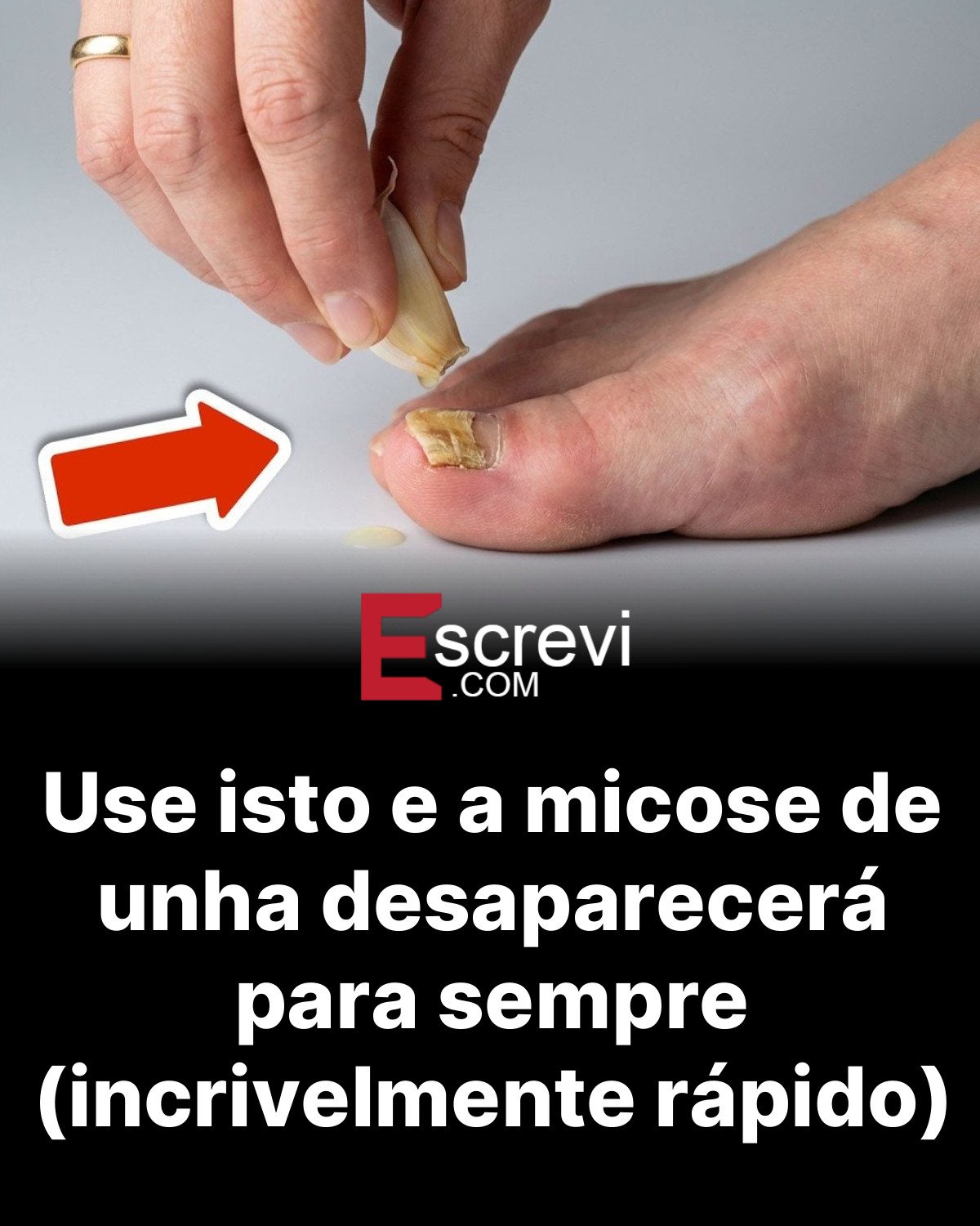 Use isto e a micose de unha desaparecerá para sempre (incrivelmente rápido) card preto