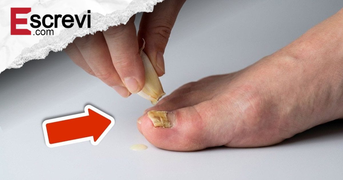 Use isto e a micose de unha desaparecerá para sempre (incrivelmente rápido) imagem principal